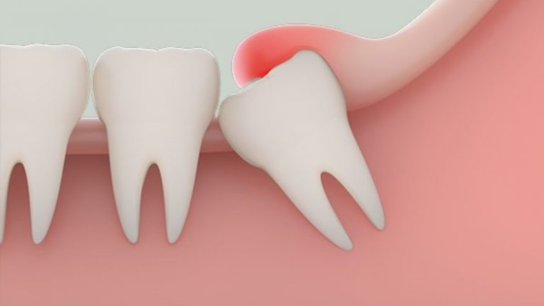 Nướu sưng đỏ là một trong những triệu chứng mọc răng khôn dễ nhận biết