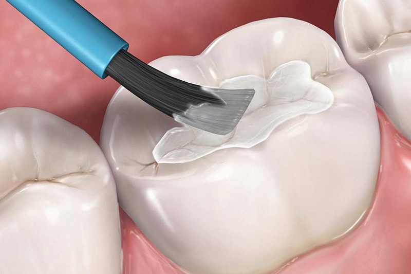 Trám răng là phương pháp điều trị sâu răng phổ biến nhất